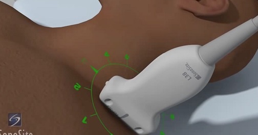 斜角筋間神経ブロック | Sonosite Institute for Point-of-Care Ultrasound